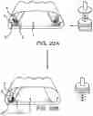 Fig. 25 - Systems and methods for mesh augmentation and prevention of incisional hernia