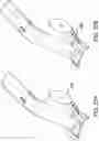 Fig. 42 - Systems and methods for mesh augmentation and prevention of incisional hernia
