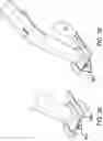 Fig. 43 - Systems and methods for mesh augmentation and prevention of incisional hernia