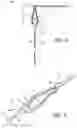 Fig. 10 - ADJUSTABLE SUTURE BUTTON CONSTRUCT