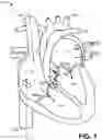 Fig. 02 - Trileaflet mechanical prosthetic heart valve