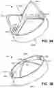Fig. 04 - Trileaflet mechanical prosthetic heart valve