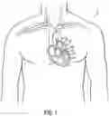 Fig. 02 - Device And Method For Improving The Function Of A Heart Valve