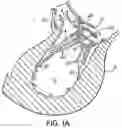 Fig. 03 - Device And Method For Improving The Function Of A Heart Valve