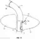 Fig. 08 - Device for Heart Repair
