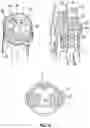 Fig. 18 - Device for Heart Repair