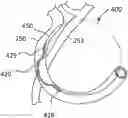 Fig. 01 - ANNULOPLASTY PROCEDURES, RELATED DEVICES AND METHODS