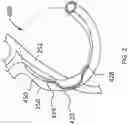 Fig. 03 - ANNULOPLASTY PROCEDURES, RELATED DEVICES AND METHODS
