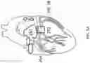Fig. 04 - ANNULOPLASTY PROCEDURES, RELATED DEVICES AND METHODS