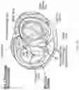 Fig. 14 - ANNULOPLASTY PROCEDURES, RELATED DEVICES AND METHODS