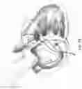 Fig. 15 - ANNULOPLASTY PROCEDURES, RELATED DEVICES AND METHODS