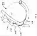 Fig. 03 - ANNULOPLASTY PROCEDURES, RELATED DEVICES AND METHODS