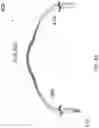 Fig. 06 - ANNULOPLASTY PROCEDURES, RELATED DEVICES AND METHODS