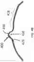 Fig. 07 - ANNULOPLASTY PROCEDURES, RELATED DEVICES AND METHODS