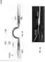 Fig. 08 - ANNULOPLASTY PROCEDURES, RELATED DEVICES AND METHODS