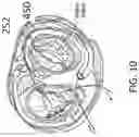 Fig. 19 - ANNULOPLASTY PROCEDURES, RELATED DEVICES AND METHODS