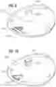 Fig. 06 - Compressible heart valve annulus sizing templates