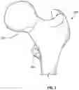 Fig. 05 - Self-Broaching Neck Preserving Hip Stem