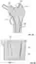 Fig. 06 - Self-Broaching Neck Preserving Hip Stem