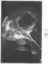 Fig. 03 - Augmented glenoid components and devices for implanting the same