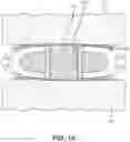 Fig. 14 - Implant with structural members arranged around a ring