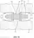 Fig. 15 - Implant with structural members arranged around a ring