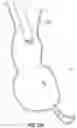 Fig. 33 - OBESITY TREATMENT DEVICES, SYSTEMS, AND METHODS