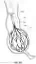 Fig. 35 - OBESITY TREATMENT DEVICES, SYSTEMS, AND METHODS