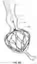 Fig. 45 - OBESITY TREATMENT DEVICES, SYSTEMS, AND METHODS