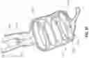 Fig. 61 - OBESITY TREATMENT DEVICES, SYSTEMS, AND METHODS