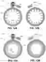 Fig. 14 - OSTOMY SYSTEMS AND METHODS