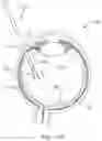 Fig. 08 - VACUUM-ASSISTED FORCEPS FOR OPHTHALMIC PROCEDURES