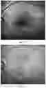 Fig. 08 - SMART AUXILIARY DIAGNOSIS SYSTEM AND METHOD FOR FUNDUS OCULI LASER SURGERY