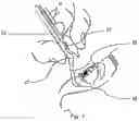 Fig. 08 - ONE-PIECE ADAPTOR DEVICE FOR OCULAR INSTILLATION OF OPHTHALMIC DROPS FROM A CONTAINER