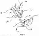 Fig. 12 - ONE-PIECE ADAPTOR DEVICE FOR OCULAR INSTILLATION OF OPHTHALMIC DROPS FROM A CONTAINER