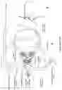 Fig. 14 - Sonic and Ultrasonic Methods and Apparatus for Treatment of Glaucoma