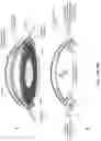 Fig. 19 - Sonic and Ultrasonic Methods and Apparatus for Treatment of Glaucoma