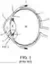 Fig. 02 - SURGICAL SYSTEM AND PROCEDURE FOR TREATMENT OF THE TRABECULAR MESHWORK AND SCHLEMM'S CANAL USING A FEMTOSECOND LASER