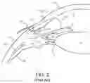 Fig. 03 - SURGICAL SYSTEM AND PROCEDURE FOR TREATMENT OF THE TRABECULAR MESHWORK AND SCHLEMM'S CANAL USING A FEMTOSECOND LASER