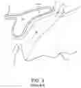 Fig. 04 - SURGICAL SYSTEM AND PROCEDURE FOR TREATMENT OF THE TRABECULAR MESHWORK AND SCHLEMM'S CANAL USING A FEMTOSECOND LASER