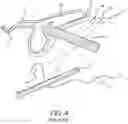 Fig. 05 - SURGICAL SYSTEM AND PROCEDURE FOR TREATMENT OF THE TRABECULAR MESHWORK AND SCHLEMM'S CANAL USING A FEMTOSECOND LASER