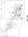 Fig. 13 - SURGICAL SYSTEM AND PROCEDURE FOR TREATMENT OF THE TRABECULAR MESHWORK AND SCHLEMM'S CANAL USING A FEMTOSECOND LASER