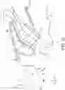 Fig. 17 - SURGICAL SYSTEM AND PROCEDURE FOR TREATMENT OF THE TRABECULAR MESHWORK AND SCHLEMM'S CANAL USING A FEMTOSECOND LASER