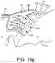 Fig. 23 - SURGICAL SYSTEM AND PROCEDURE FOR TREATMENT OF THE TRABECULAR MESHWORK AND SCHLEMM'S CANAL USING A FEMTOSECOND LASER