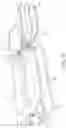 Fig. 22 - Patient turning device for a patient support apparatus