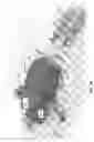Fig. 20 - APPARATUS FOR DELIVERY OF RADIOEMBOLIZATION MICROSPHERES