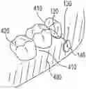 Fig. 01 - ORAL CAVITY MEDICAMENT DELIVERY DEVICE