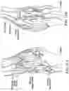 Fig. 33 - Implantable depots for the controlled release of therapeutic agents