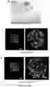 Fig. 31 - NANOFIBROUS ENCAPSULATION DEVICE FOR SAFE DELIVERY OF THERAPEUTIC AGENTS