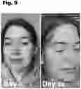 Fig. 10 - SKIN CLARIFIER